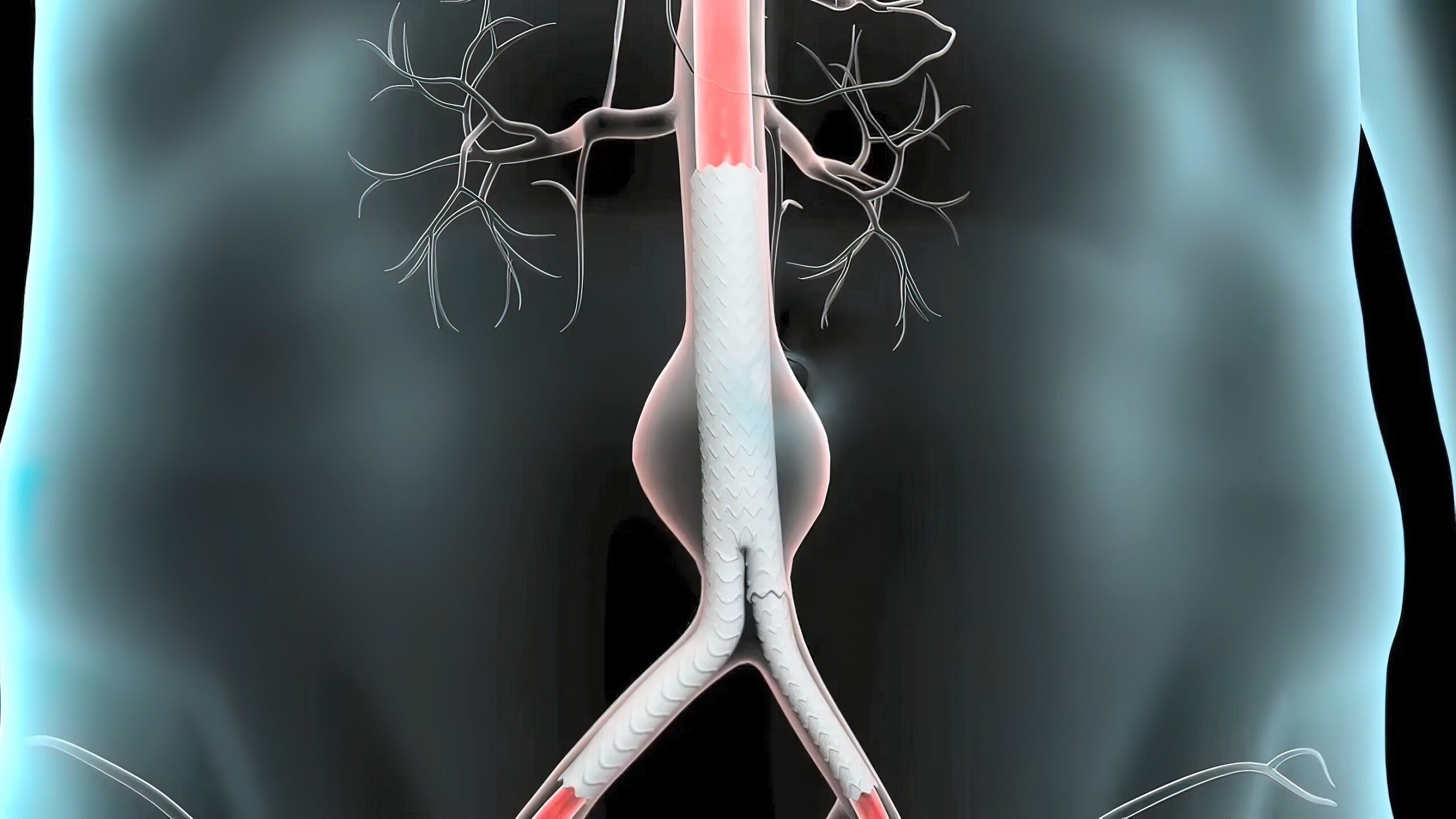 Склероз брюшной аорты. Стент графт брюшной аорты. Стентирование аневризмы брюшной аорты. Стент графт брюшной аорты Анаконда.